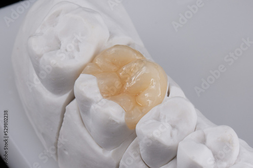 Dental ceramic Inlay photo