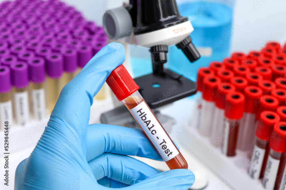 HbA1c test from blood , Blood samples to be analyzed in the laboratory