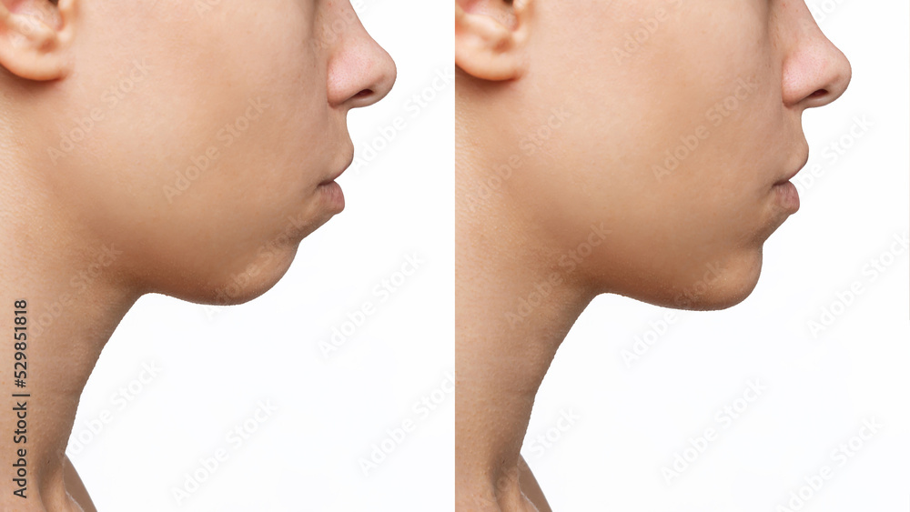 Сhin reduction. Cropped shot of woman's face with chin before and after mentoplasty isolated on a white background. The result of cosmetic plastic surgery. Profile. Сorrection of malocclusion - obrazy, fototapety, plakaty 