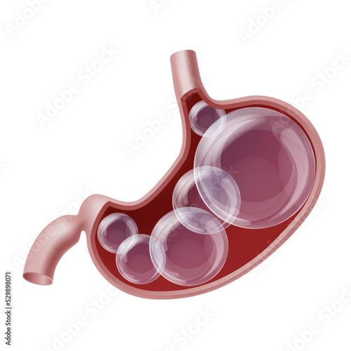 Bloated stomach with gases transparent balls inside. Digestive system bloating problem