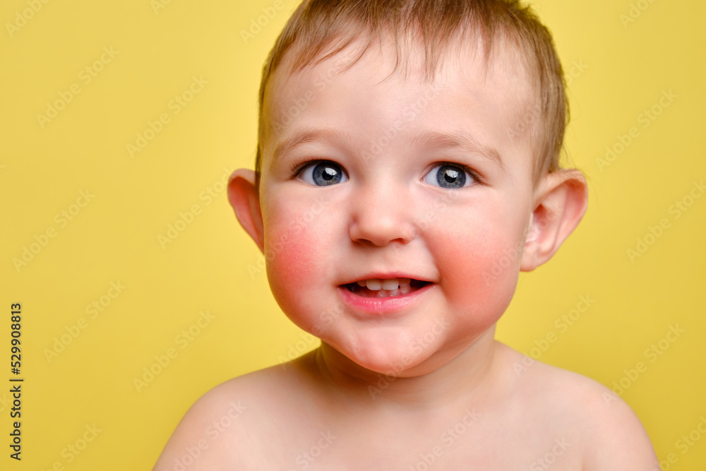 Happy toddler baby with allergies on her face, studio yellow background. Portrait of a smiling allergic child with red cheeks. Kid age one year and two months Happy toddler baby with allergies on her face, studio yellow background. Portrait of a smiling allergic child with red cheeks. Kid age one year and two months