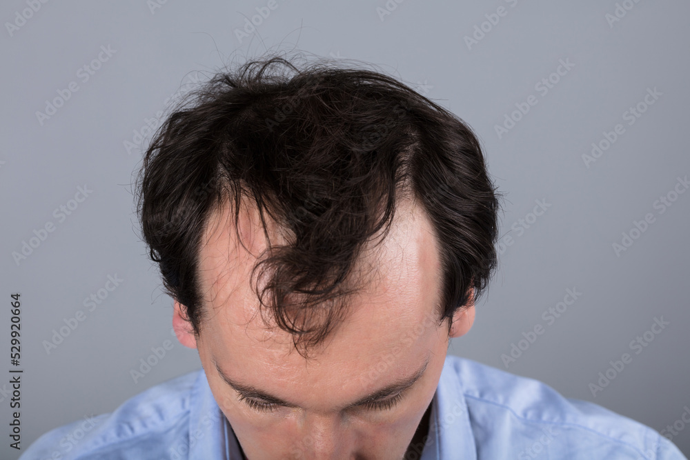 Fototapeta premium Man With Hair Loss Symptoms
