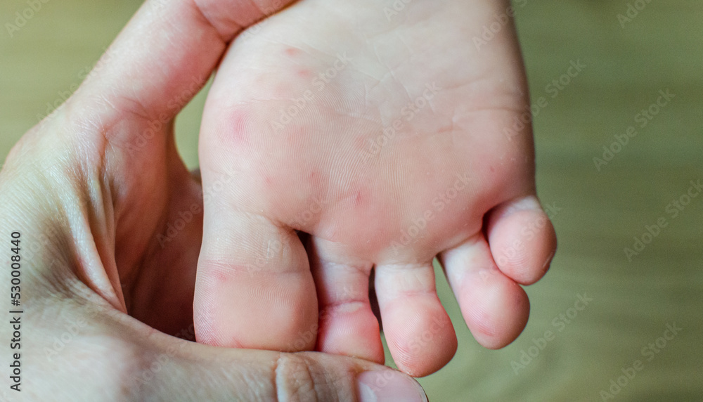 Enterovirus Feet Rash on the body of a child. Cocksackie virus rash
