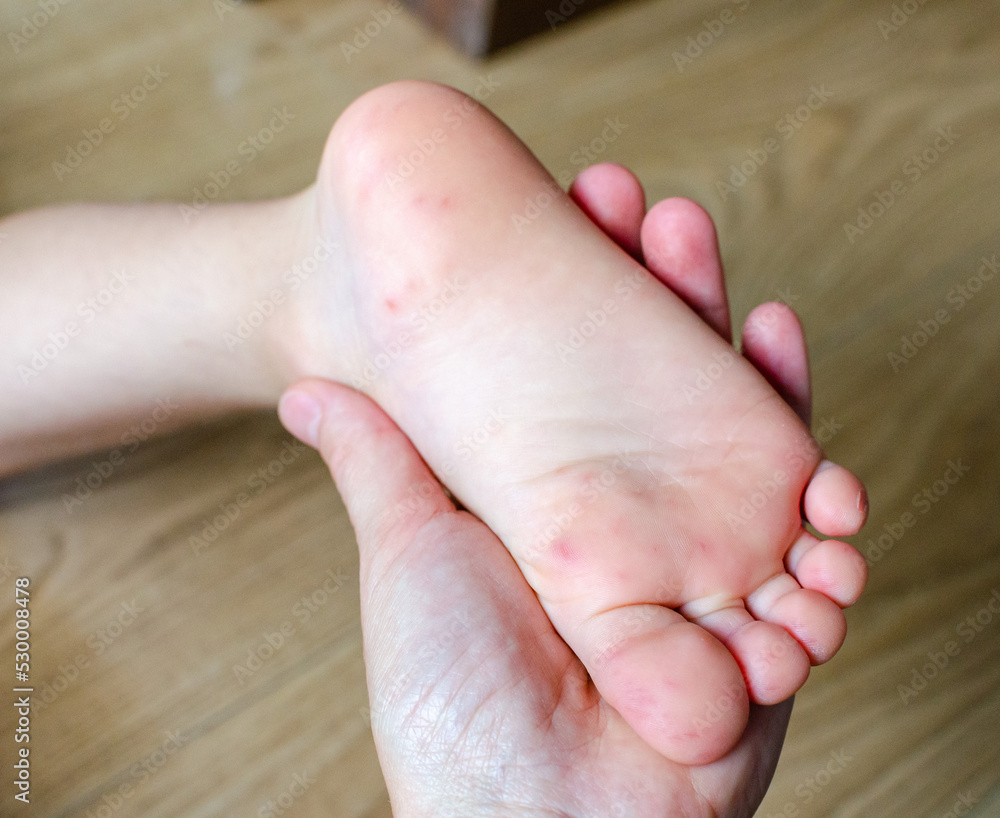 Enterovirus Feet Rash on the body of a child. Cocksackie virus rash