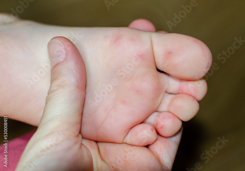 Enterovirus Feet Rash on the body of a child. Cocksackie virus rash beginning initial stage, spots on the feet. photo
