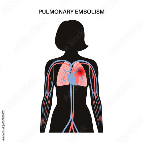 Pulmonary embolism disease
