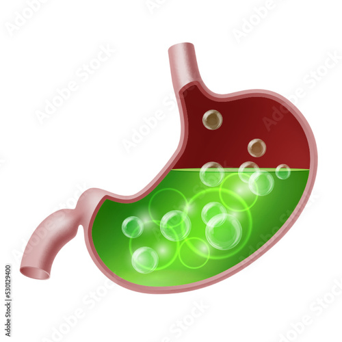 Stomach suffering from acid reflux. Gastroesophageal reflux disease.