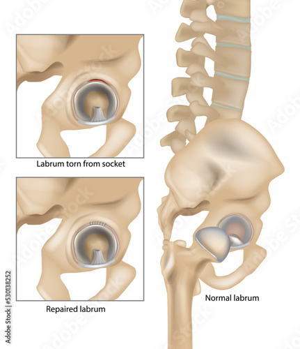 Hip Labral Tears. Labrum torn from socket and Repaired labrum. Surgery for Repairing a Torn Hip Labral. Vector photo