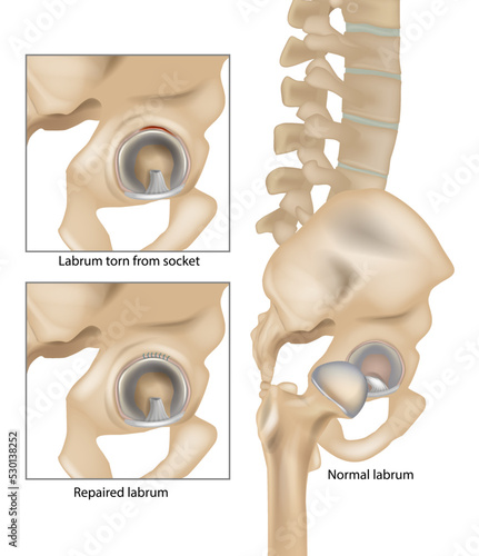 Hip Labral Tears. Labrum torn from socket and Repaired labrum. Surgery for Repairing a Torn Hip Labral. Vector