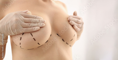 Woman with marks on chest for breast augmentation photo