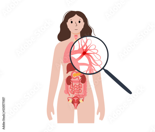 Pulmonary embolism disease