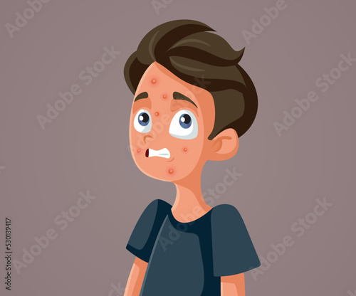 Stressed Teen Boy Fighting Acne Skin Problem During Puberty. Teenager fighting skin condition during his adolescence years
