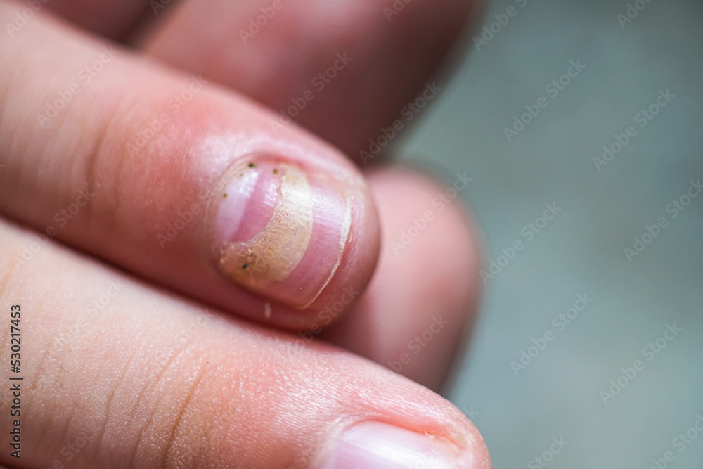 Mechanical damage to the nail plate. Nail Changes Occurring Secondary effect after HandFoot