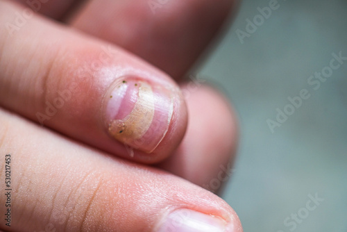 Mechanical damage to the nail plate. Nail Changes Occurring Secondary effect after Hand-Foot-Mouth Disease of kid. Herpangina disease, HFMD.
 photo