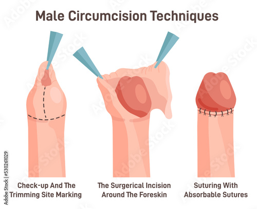 Circumcision technique. Surgical removal of the foreskin on the penis of  man. Stock Vector