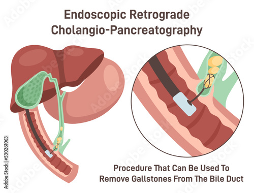 Endoscopic retrograde cholangiopancreatography. ERCP, bile duct diagnosis. photo