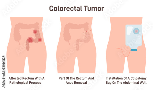 Colostomy bag installation. Colon cancer procedure. Operation photo