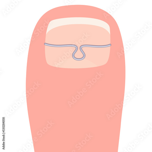 Thumb with a titanium staple for correction of the shape of the toenail cartoon vector illustration isolated on a white background
