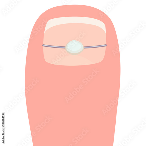 Thumb with a titanium staple for correction of the shape of the toenail. Thumb cartoon vector illustration isolated on a white background