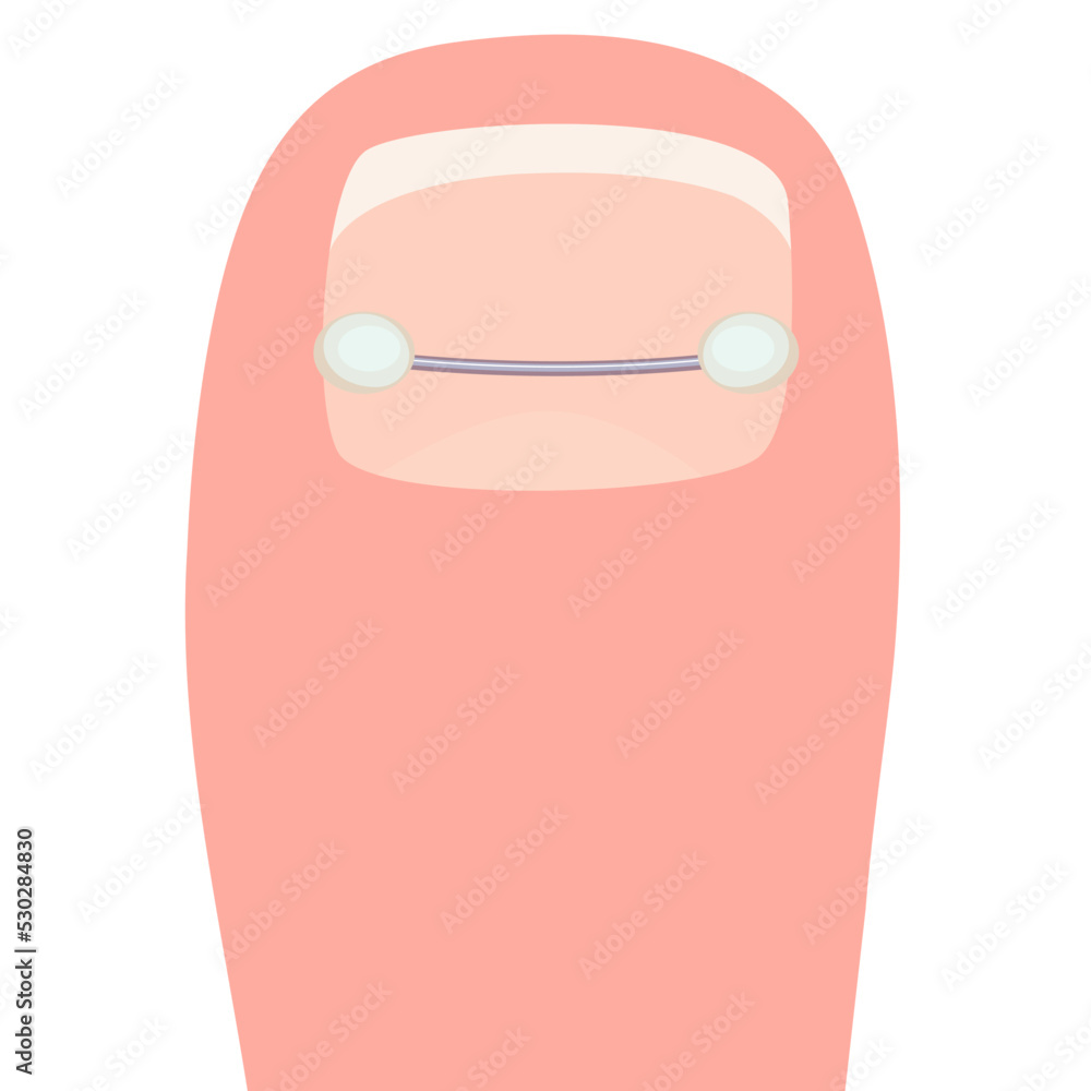 Thumb with a titanium staple for correction of the shape of the toenail cartoon vector illustration isolated on a white background Thumb with a titanium staple for correction of the shape of the toenail cartoon vector illustration isolated on a white background
