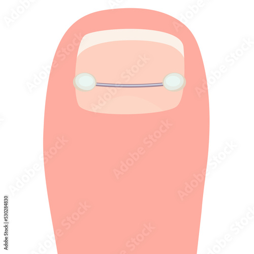 Thumb with a titanium staple for correction of the shape of the toenail cartoon vector illustration isolated on a white background