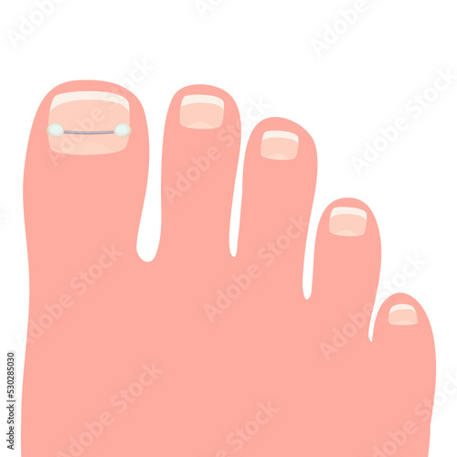 Toes on the right foot with a titanium staple on the thumb for correction of the shape of the toenail cartoon vector illustration isolated on a white background