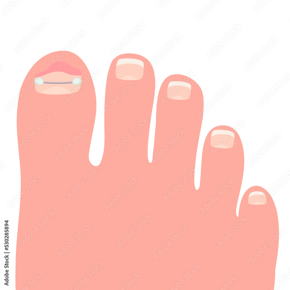 Toes on the right foot with a titanium staple on the thumb for correction of the shape of the toenail cartoon vector illustration isolated on a white background Toes on the right foot with a titanium staple on the thumb for correction of the shape of the toenail cartoon vector illustration isolated on a white background