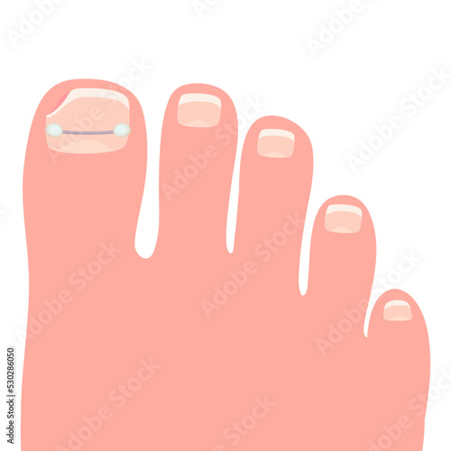 Toes on the right foot with a titanium staple on the thumb for correction of the shape of the toenail cartoon vector illustration isolated on a white background