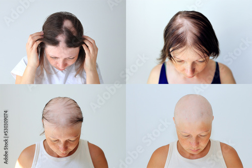 Stages of female head baldness during autoimmune alopecia. Baldness during chemotherapy for cancer