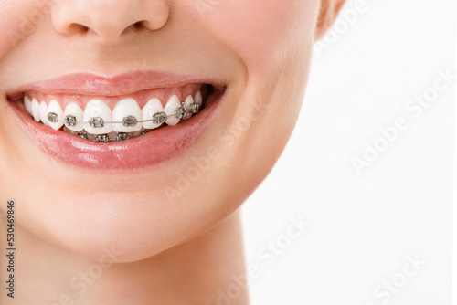 A smiling woman with metal braces. Close-up