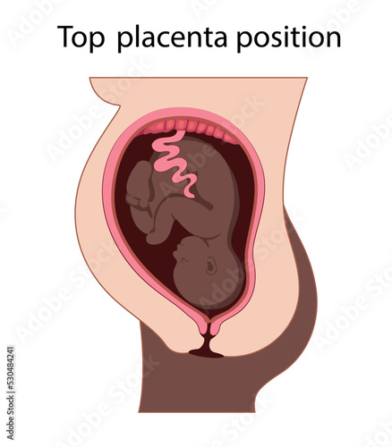 Fetus in Uterus During Pregnancy. Top Placental Locations Woman with dark skin.  Pathology. 
Detailed Medical vector illustration.
