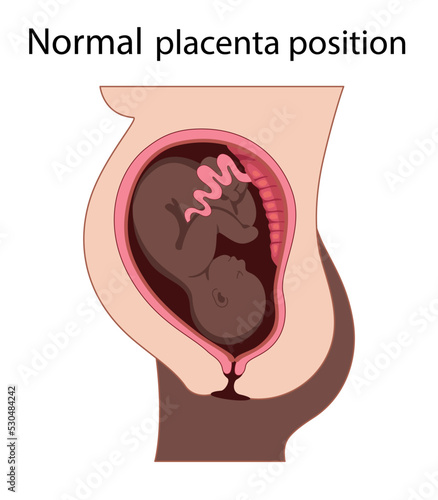 Fetus in Uterus During Pregnancy. Normal Placental Locations Woman with dark skin.  Pathology. 
Detailed Medical vector illustration.

