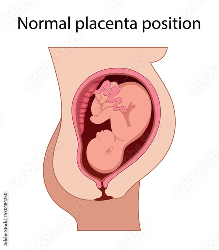 Fetus in Uterus During Pregnancy. Normal Placental Locations.  Pathology. 
Detailed Medical vector illustration.
