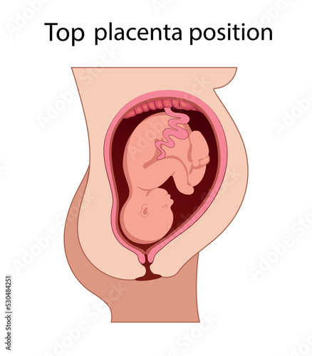 Fetus in Uterus During Pregnancy. Top Placental Locations.  Pathology. 
Detailed Medical vector illustration.
