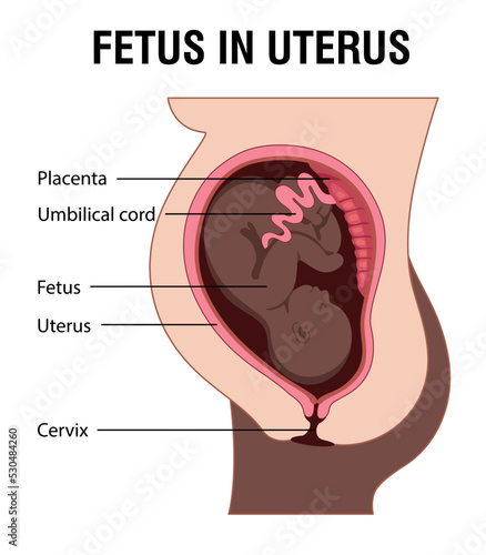 Fetus in Uterus During Pregnancy. Placental Locations Woman with dark skin.  Pathology. 
Detailed Medical vector illustration.
