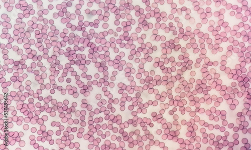 Microscopic view of hematological stained slide. thrombocytopenia. Extremely low level of platelet count in blood.