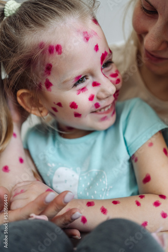 Little girl ill with chickenpox at home. High quality photo