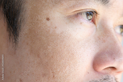 Close up Asian man face with freckles dark spots from uv light , skin care and health problem concept photo