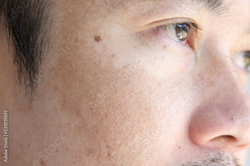 Canvas Print Close up Asian man face with freckles dark spots from uv light , skin care and h
