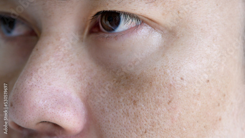 Close up Asian man face with freckles dark spots from uv light , skin care and health problem concept photo