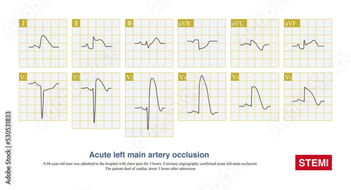 Tableau sur toile Acute left main artery occlusion can cause both ST segment elevation and non ST segment elevation myocardial infarction, regardless of which type, the risk of death is high