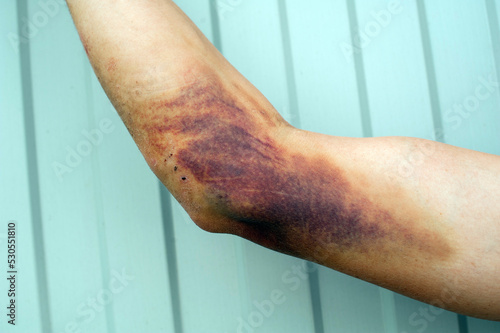 hematoma on the arm close-up.Bruise on the arm after the fall.a large hematoma on the man's arm.injury after falling from a motorcycle
