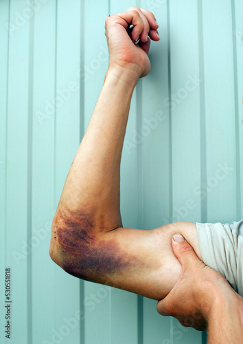 scratches and bruise on the arm after falling from a motorcycle.scratches and a bruise on the arm.Bruise on the arm.ihematoma on the man's elbow.njury scratches and bruises.