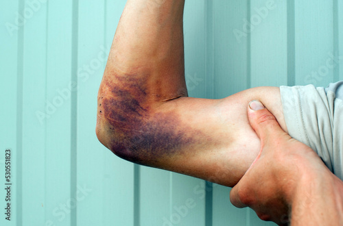 hematoma on the arm close-up.Bruise on the arm after the fall.a large hematoma on the man's arm.injury after falling from a motorcycle