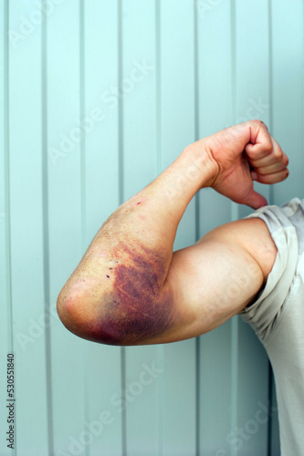 hematoma on the arm close-up.Bruise on the arm after the fall.a large hematoma on the man's arm.injury after falling from a motorcycle