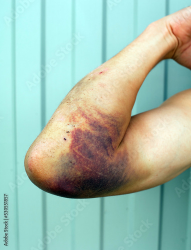 scratches and bruise on the arm after falling from a motorcycle.scratches and a bruise on the arm.Bruise on the arm.ihematoma on the man's elbow.njury scratches and bruises.Injury on the arm after a f
