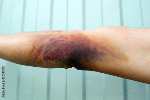 hematoma on the arm close-up.Bruise on the arm after the fall.a large hematoma on the man's arm.injury after falling from a motorcycle