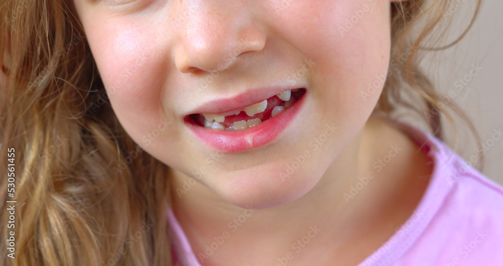 A close-up of the smile of a little girl without milk teeth, with growing permanent teeth. A close-up of the smile of a little girl without milk teeth, with growing permanent teeth.