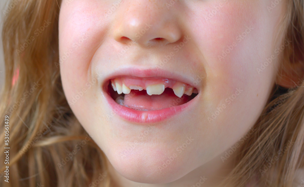 A close-up of the smile of a little girl without milk teeth, with growing permanent teeth. A close-up of the smile of a little girl without milk teeth, with growing permanent teeth.