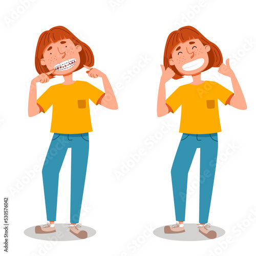 A pretty girl shows a smile with braces and without braces. Vector illustration in a flat style on the topic of dentistry.